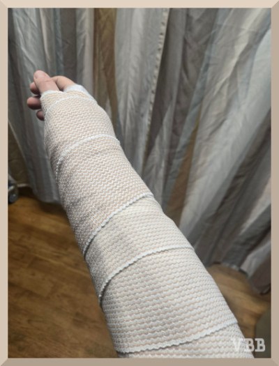 Photo of person's wrist in a splint and an stretch wrap.